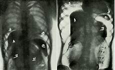 Diaphragm