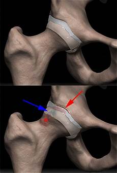 Femoral