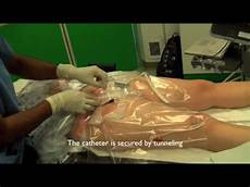 Femoral