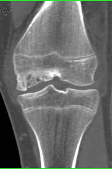 Femoral