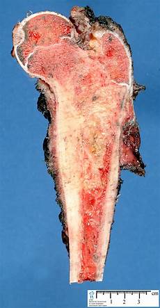 Femoral