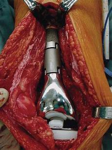 Hip Prosthesis