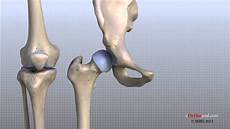 Hip Prosthesis
