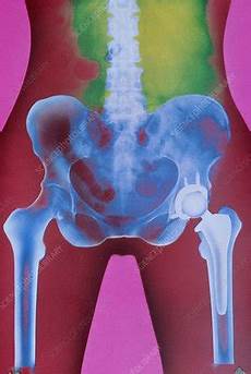 Hip Prosthesis