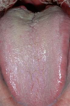 Oral Spray