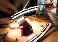 Surgical instruments