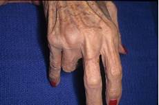 Tendon Bands