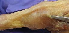 Tendon Bands