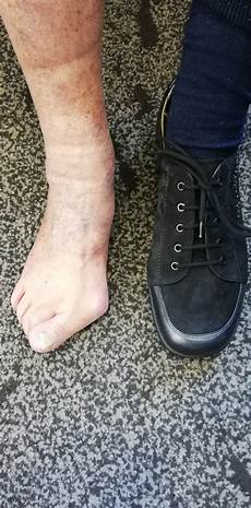 Valgus Reels